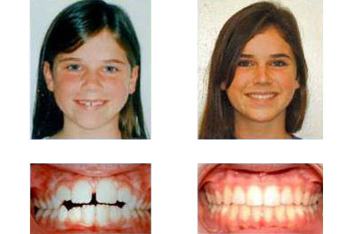 before and after braces