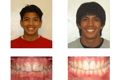 before and after braces