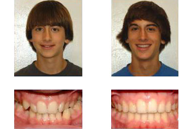 before and after braces