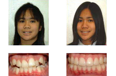 before and after braces