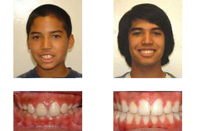 before and after braces