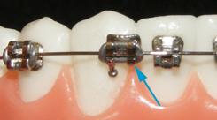 A diagram displaying a broken braces bracket.