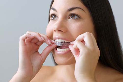 A woman puts on a top row of Invisalign.