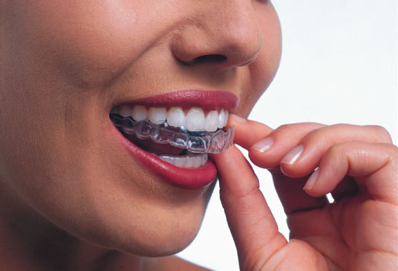 A smiling woman puts in her Invisalign. The shot shows how the Invisalign matches her row of upper teeth.