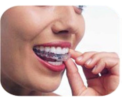 A woman puts on a top row of Invisalign.