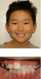 before and after braces