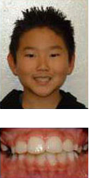 before and after braces