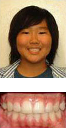 before and after braces