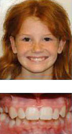 before and after braces
