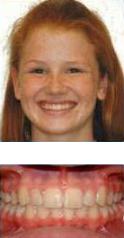 before and after braces