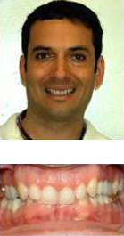 before and after braces