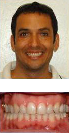 before and after braces