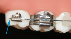 A diagram displaying how wire is used and inserted in braces.