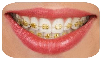 A woman smiles showing off her gold-colored braces.