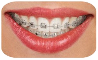 A woman smiles showing off her standard braces.
