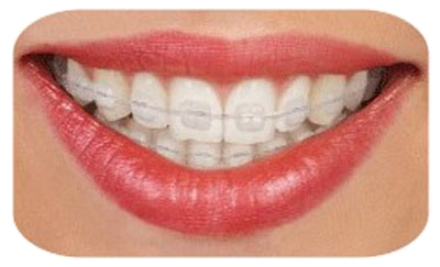 A woman smiles showing off her clear braces.